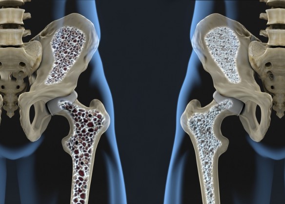 Illustration d'une ostéoporose